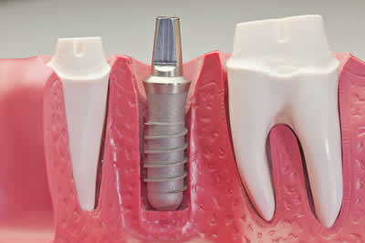 implantologia-dentale-transmucosa.jpg